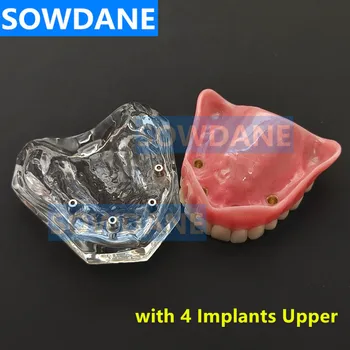 Zubný Implantát Obnova Zuby Model Vymeniteľné Most Protézy Ochorenia Zubov Model S Obnovy Mosta Učiteľské Študijné
