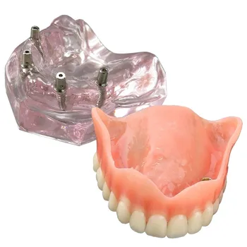 Zubné Model Overdenture Horné Zuby 4 Implantáty Demo pre Výučbu a Štúdium